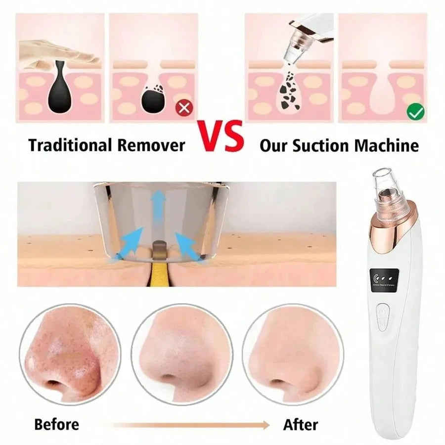Aspirateur nettoyant pour pores en profondeur – Outil de beauté électrique pour points noirs et acné