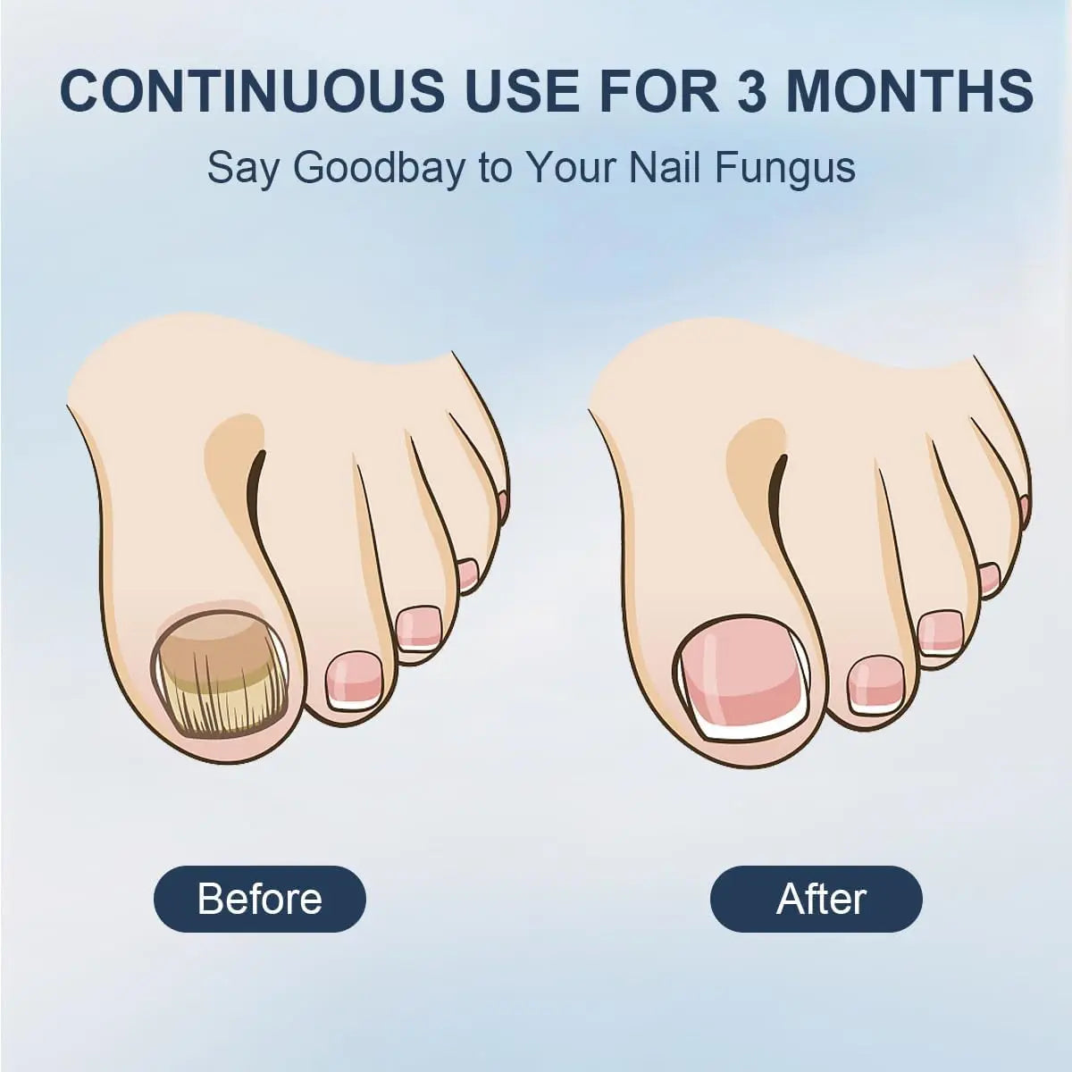 48W Laser Nail Fungus Treatment Device – Blue & Infrared Light