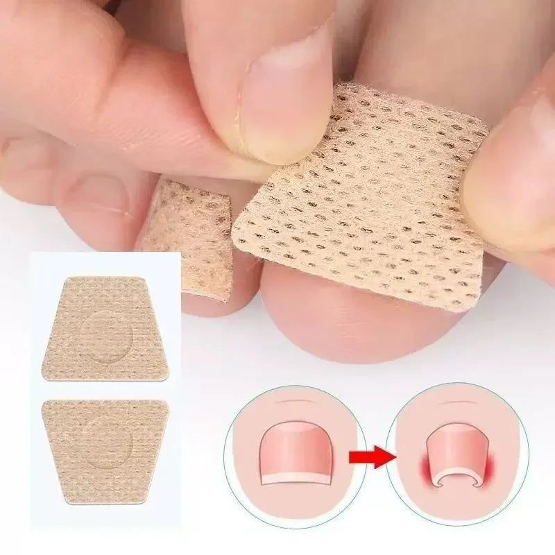 Patchs réparateurs pour ongles d'orteils (10 pièces) – Soutien pour les ongles incarnés et abîmés