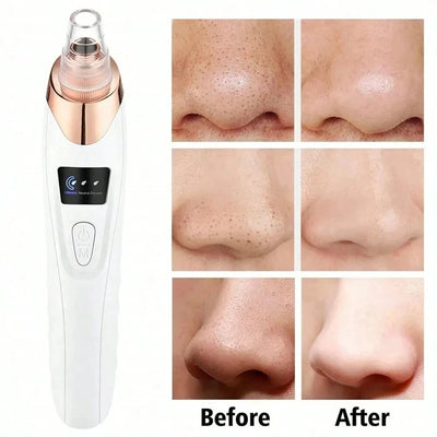Deep Pore Cleansing Vacuum – Electric Blackhead & Acne Beauty Tool