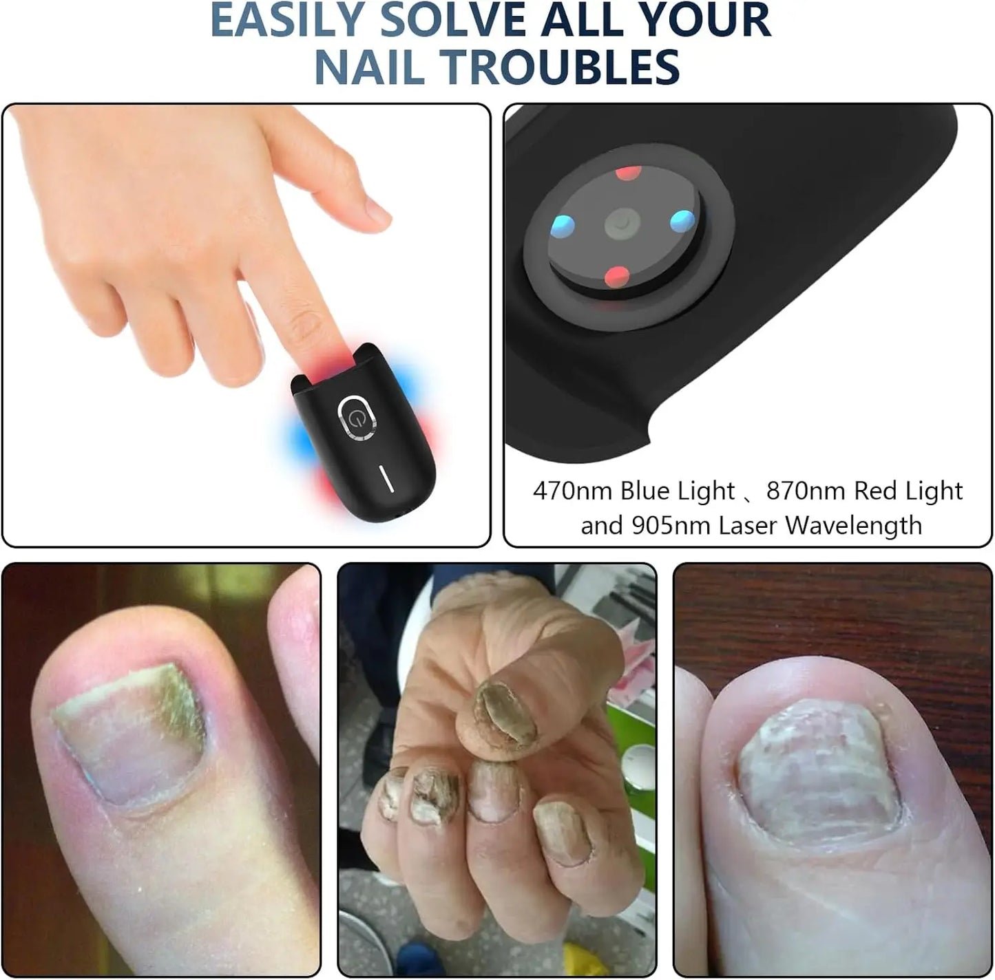 Laserbehandelingsapparaat voor nagelschimmel – Blauw, Rood & Pulserend Licht