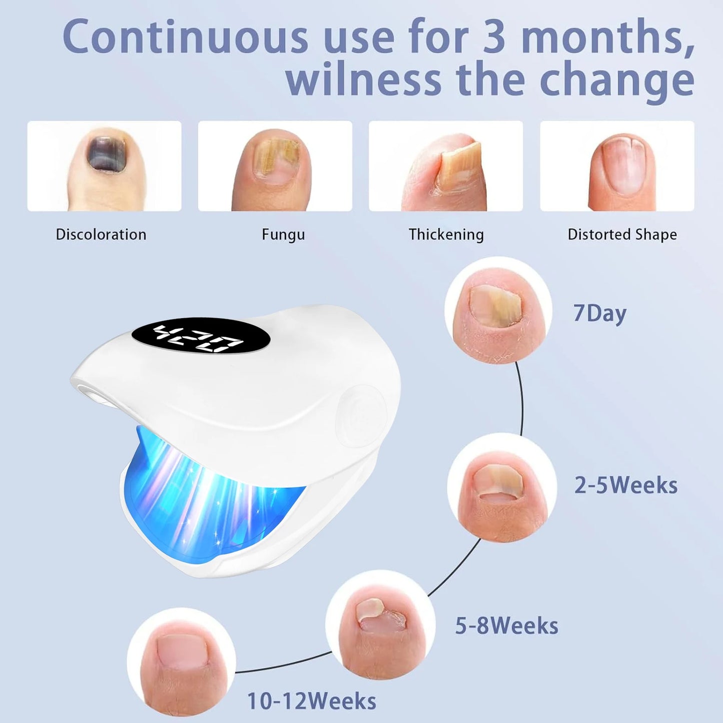 Wireless Nail Fungus Treatment Laser – Blue Light