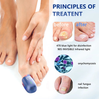 Nail Fungus Laser Device – Toenail Fungus Remover