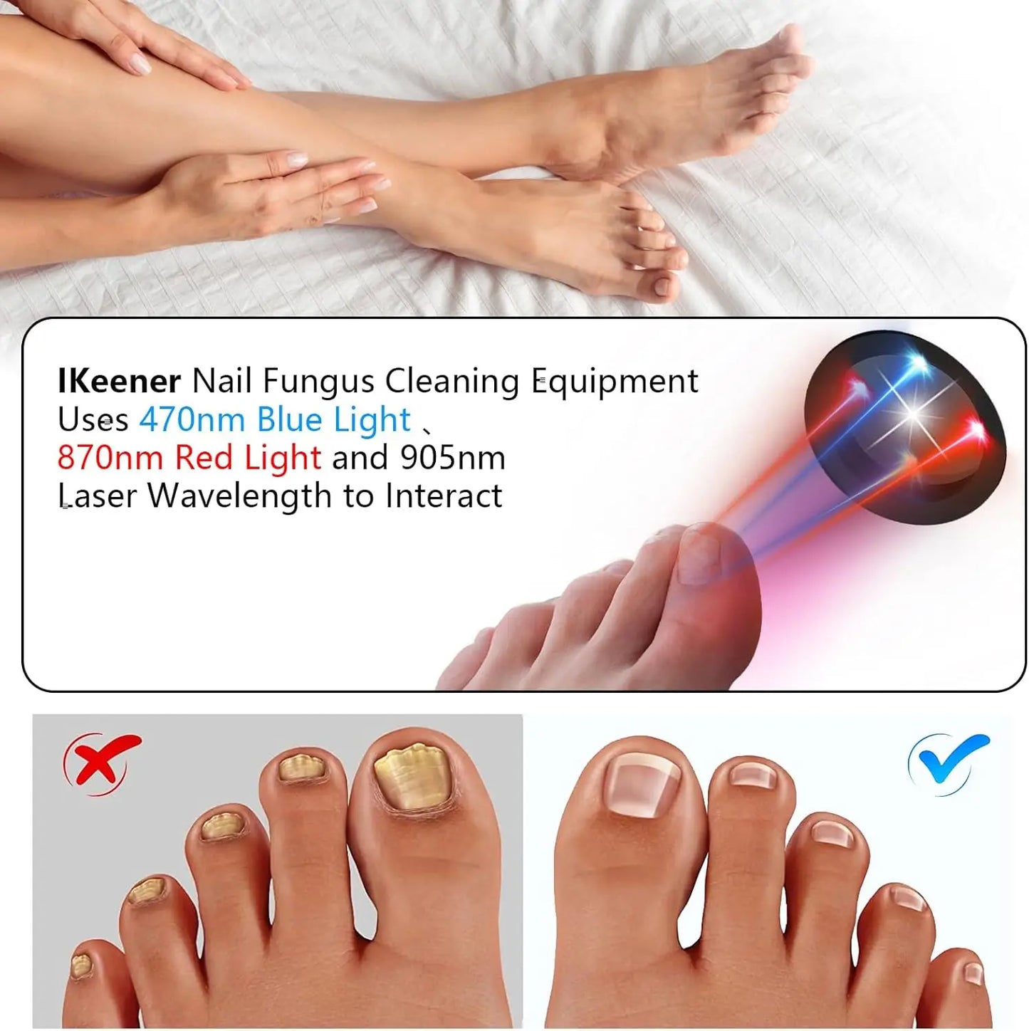 Laserbehandelingsapparaat voor nagelschimmel – Blauw, Rood & Pulserend Licht
