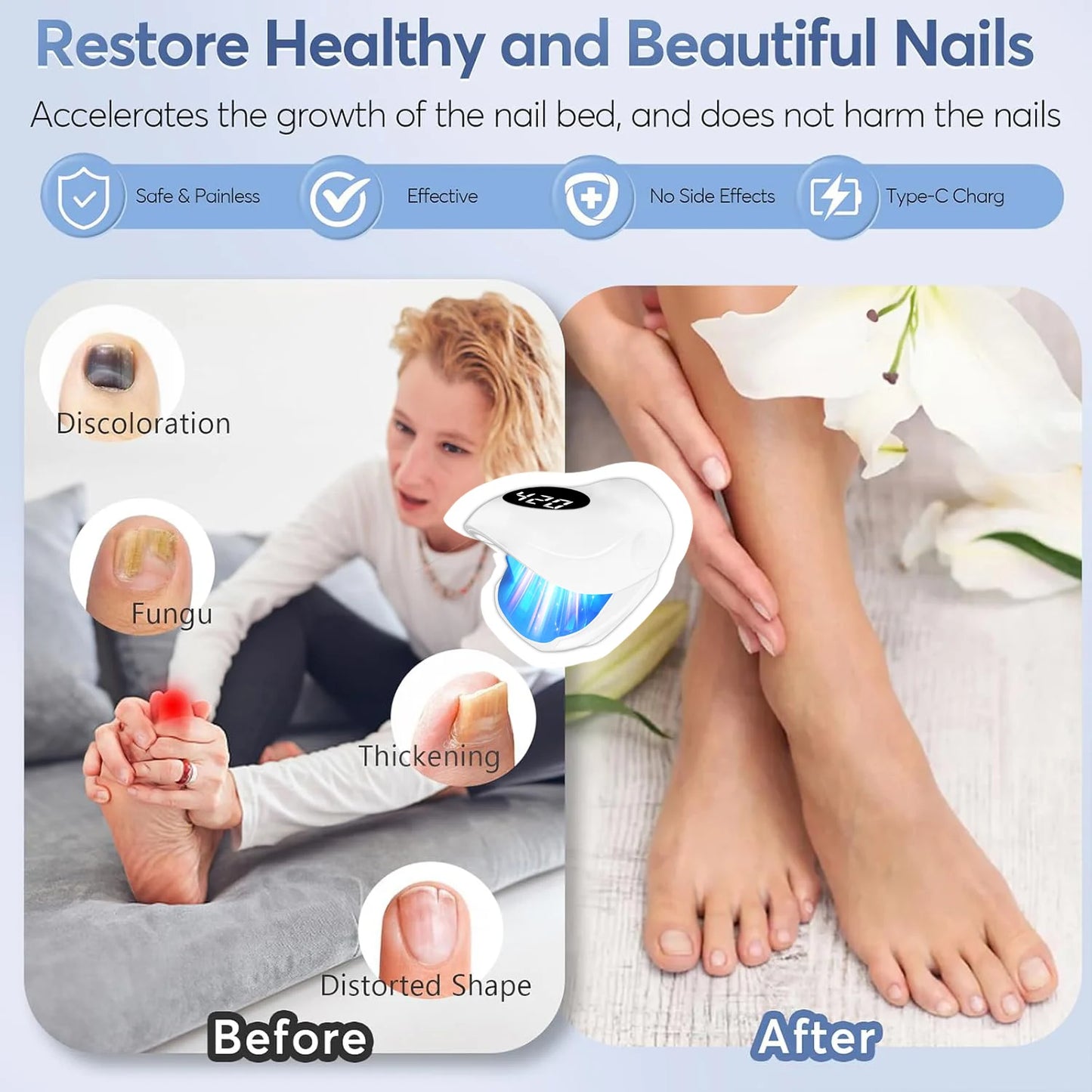 Wireless Nail Fungus Treatment Laser – Blue Light