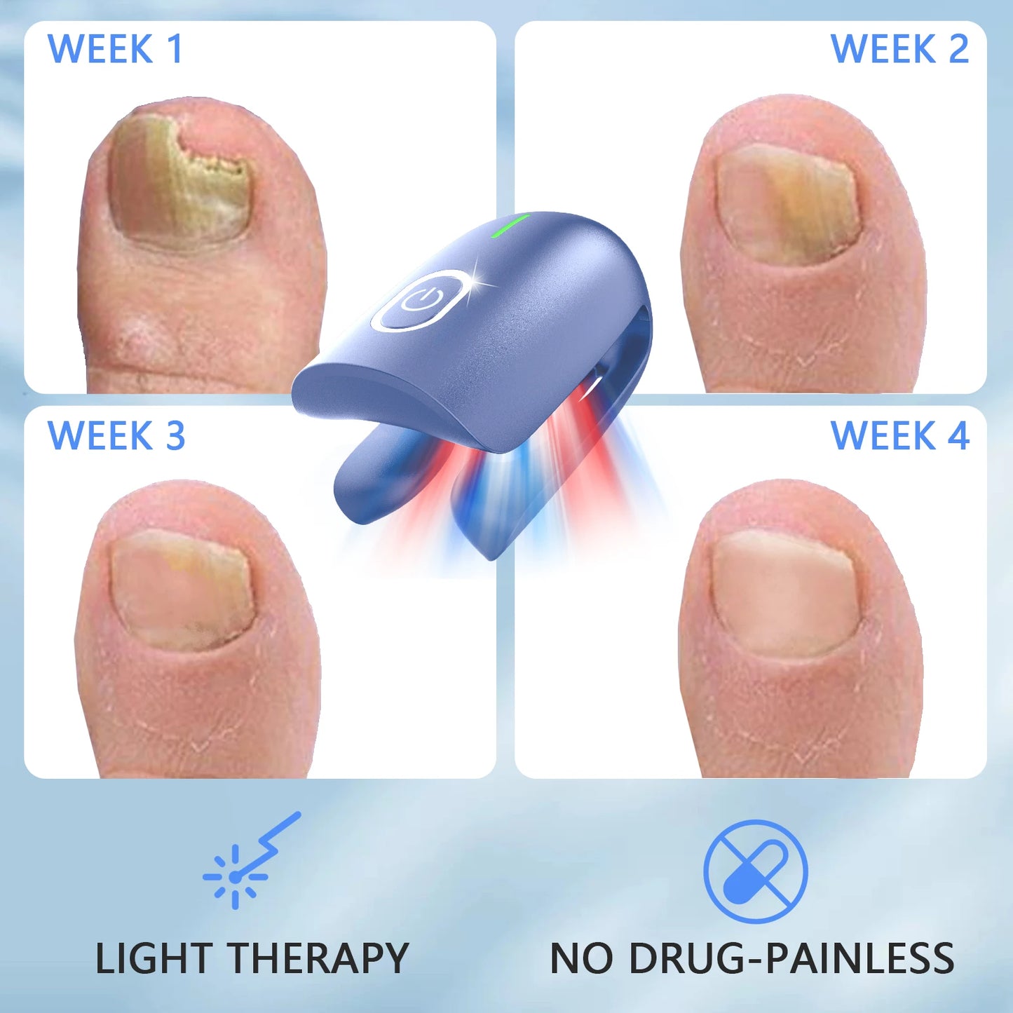 Nail Fungus Laser Device – Toenail Fungus Remover