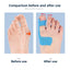 10-Pack Hallux Valgus Bunion Correction Tape