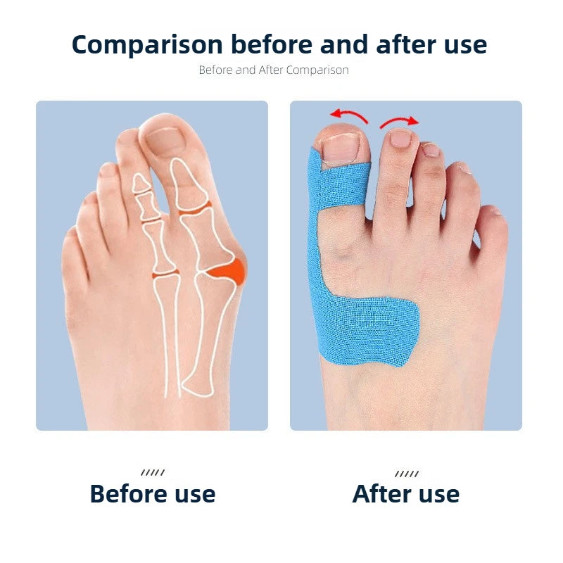 10-Pack Hallux Valgus Bunion Correction Tape