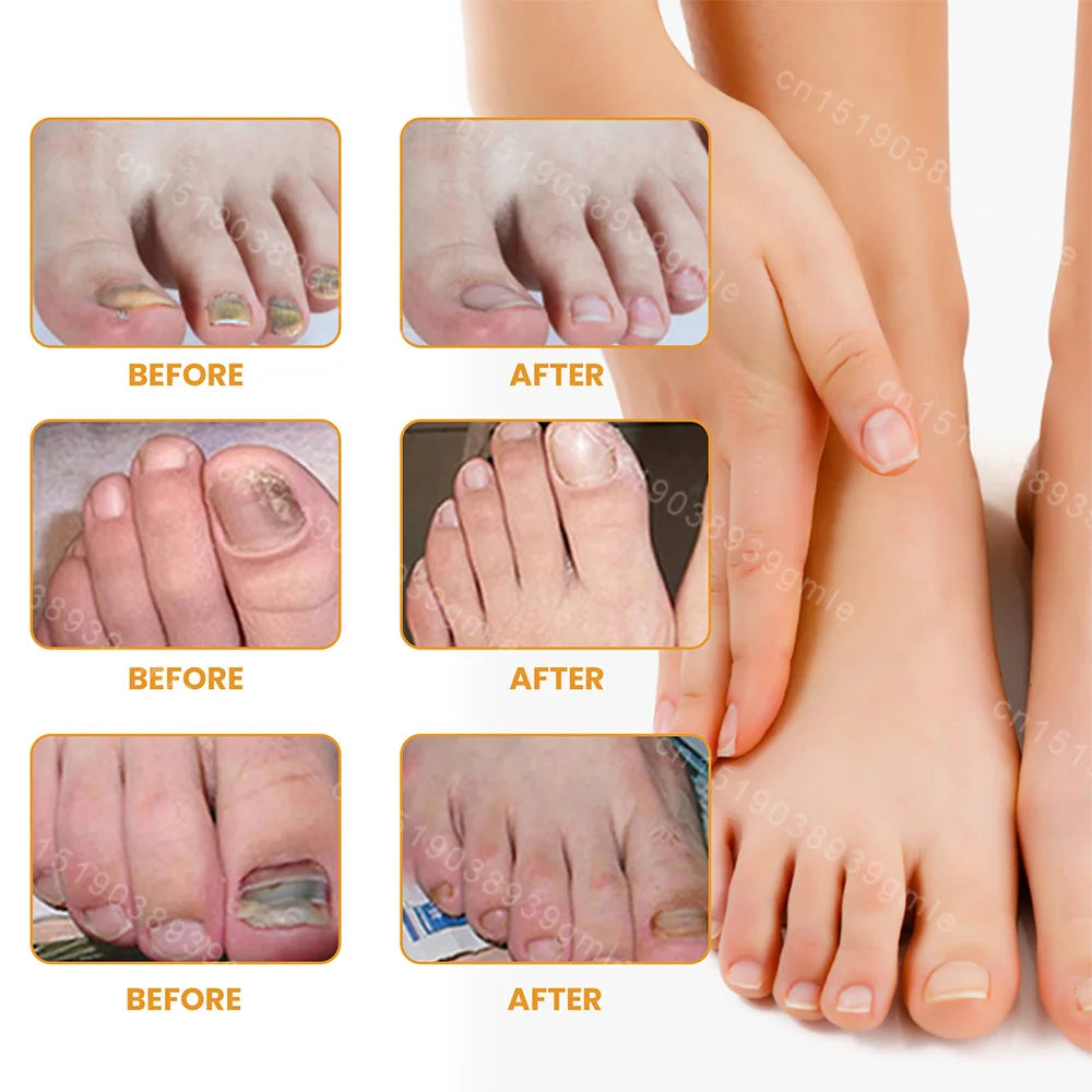 Patchs réparateurs pour ongles d'orteils (10 pièces) – Soutien pour les ongles incarnés et abîmés
