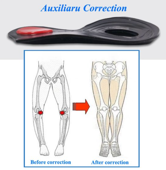 Siliconen orthopedische inlegzolen voor O/X-benen – Verlichting van valgus- en varuspijn