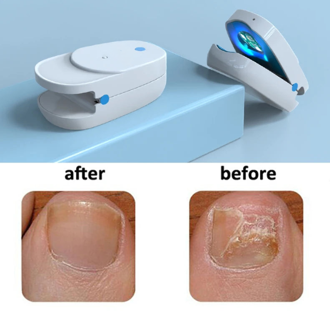 Appareil laser pour l'élimination des mycoses des ongles des orteils et des doigts