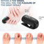 Laserbehandelingsapparaat voor nagelschimmel – Blauw, Rood & Pulserend Licht