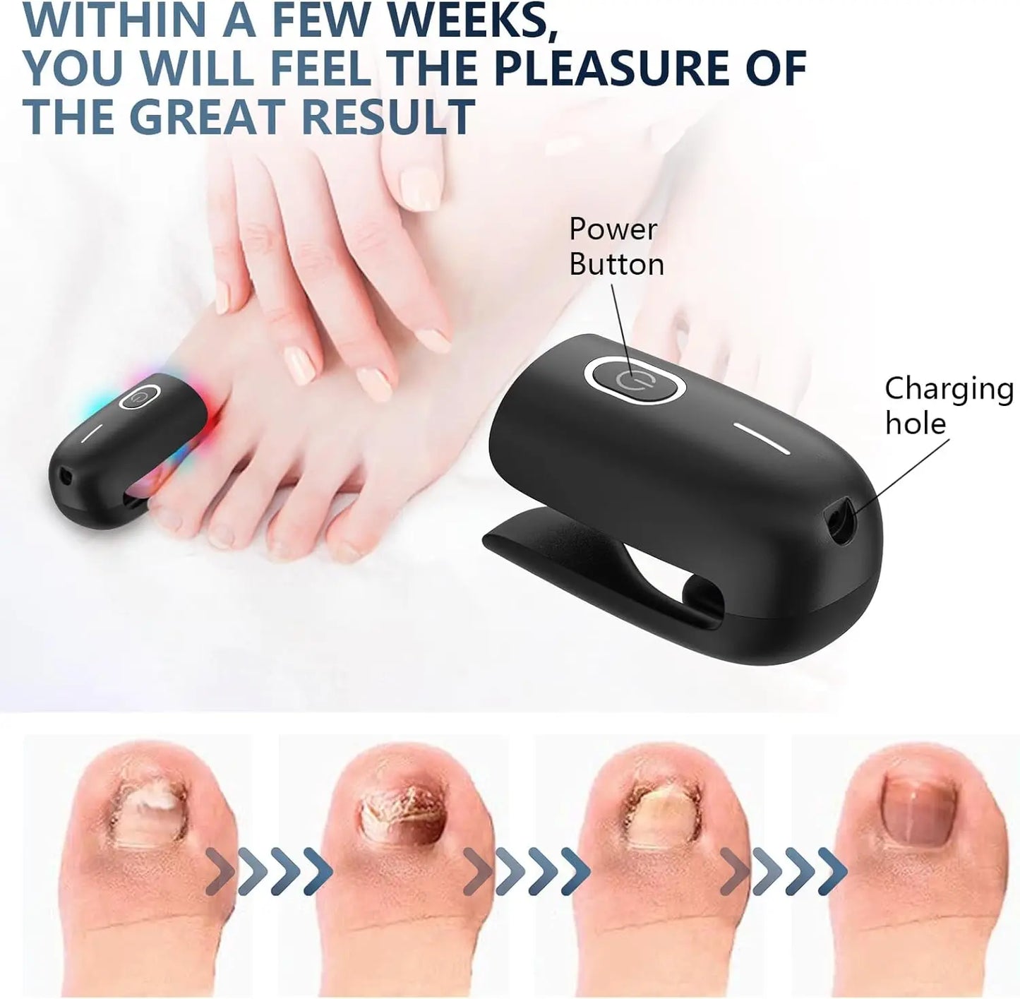 Laserbehandelingsapparaat voor nagelschimmel – Blauw, Rood & Pulserend Licht