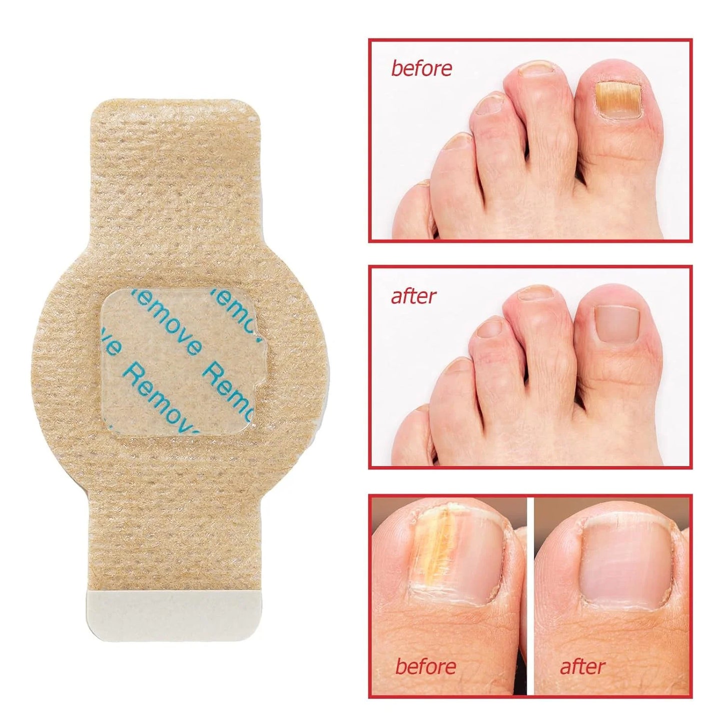 Nail Fungus & Ingrown Toenail Patch – Waterproof Foot Repair