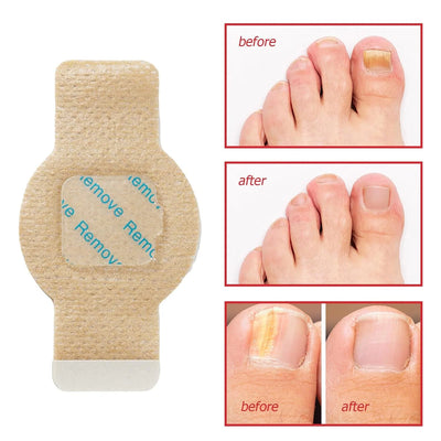 Nail Fungus & Ingrown Toenail Patch – Waterproof Foot Repair