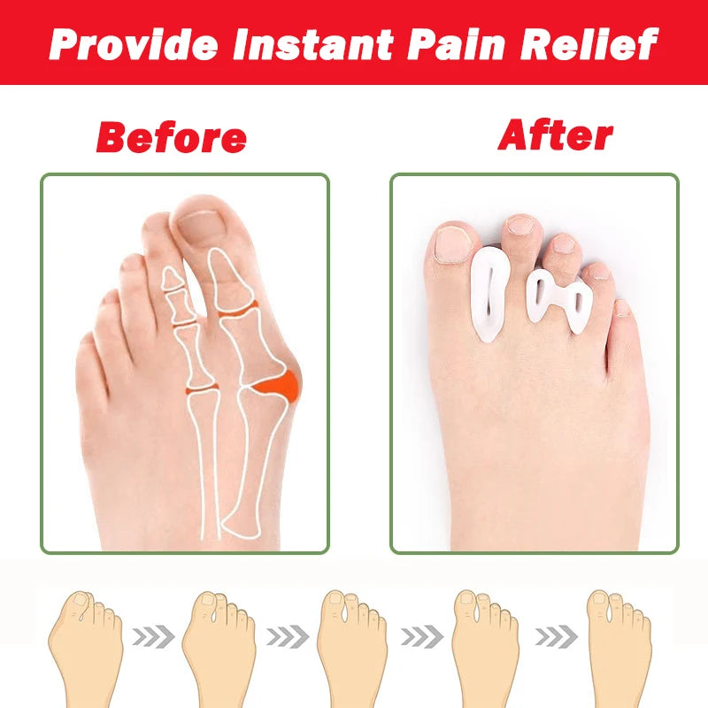 Gel Teen Spreiders & Voorvoetkussens – Hallux Valgus Teen Corrector